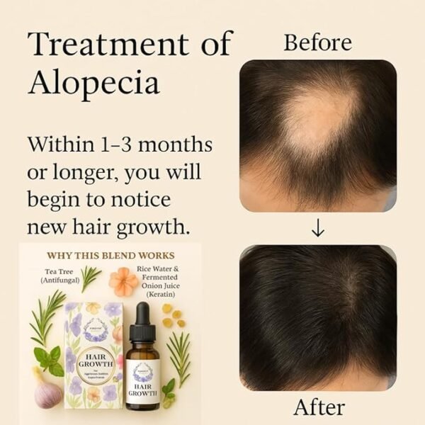 Forever Flourish (Holistic) Ayurvedic Hair Growth Oil for Vata Prakriti – With Rosemary, Lavender, Cedarwood, Rice Water & Onion Juice – Nourishes Dry Scalp, Boosts Hair Growth, (Customizable) - Image 3